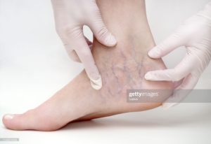 Sclerotherapy injection for spider and varicose veins