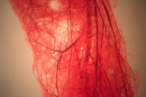 Blood Vessels of human leg and varicose veins