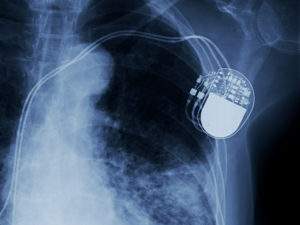 x-ray image of permanent pacemaker implant in chest body , process in blue tone